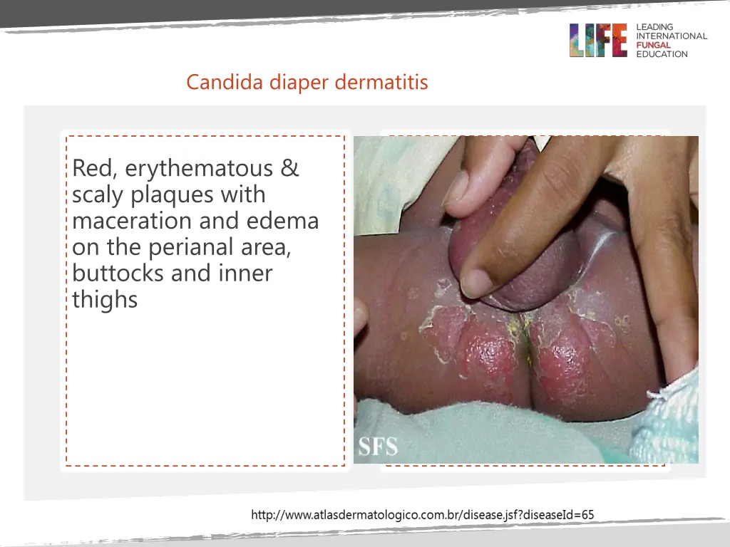 candida diaper dermatitis
