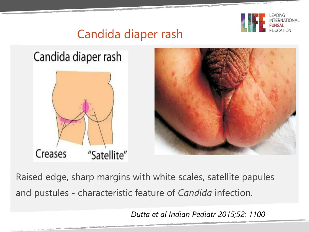 candida diaper rash