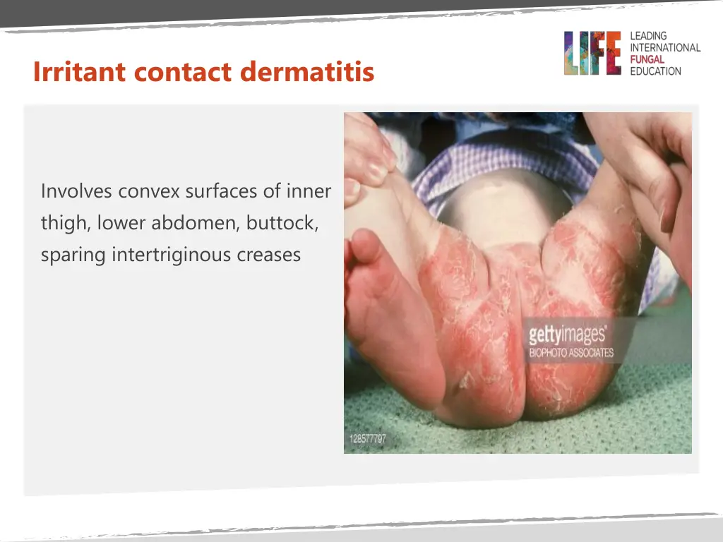 irritant contact dermatitis