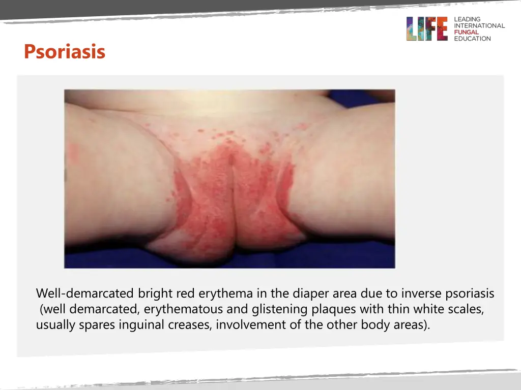 psoriasis