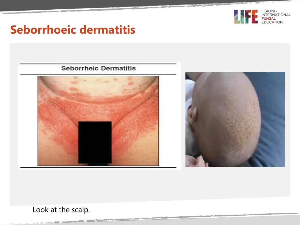 seborrhoeic dermatitis