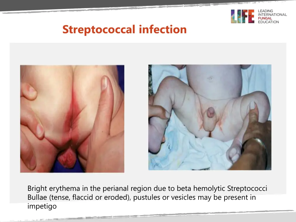 streptococcal infection