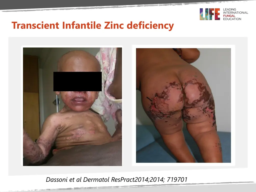 transcient infantile zinc deficiency