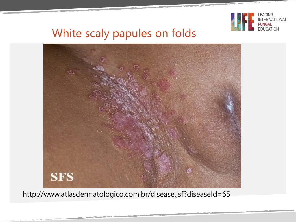 white scaly papules on folds
