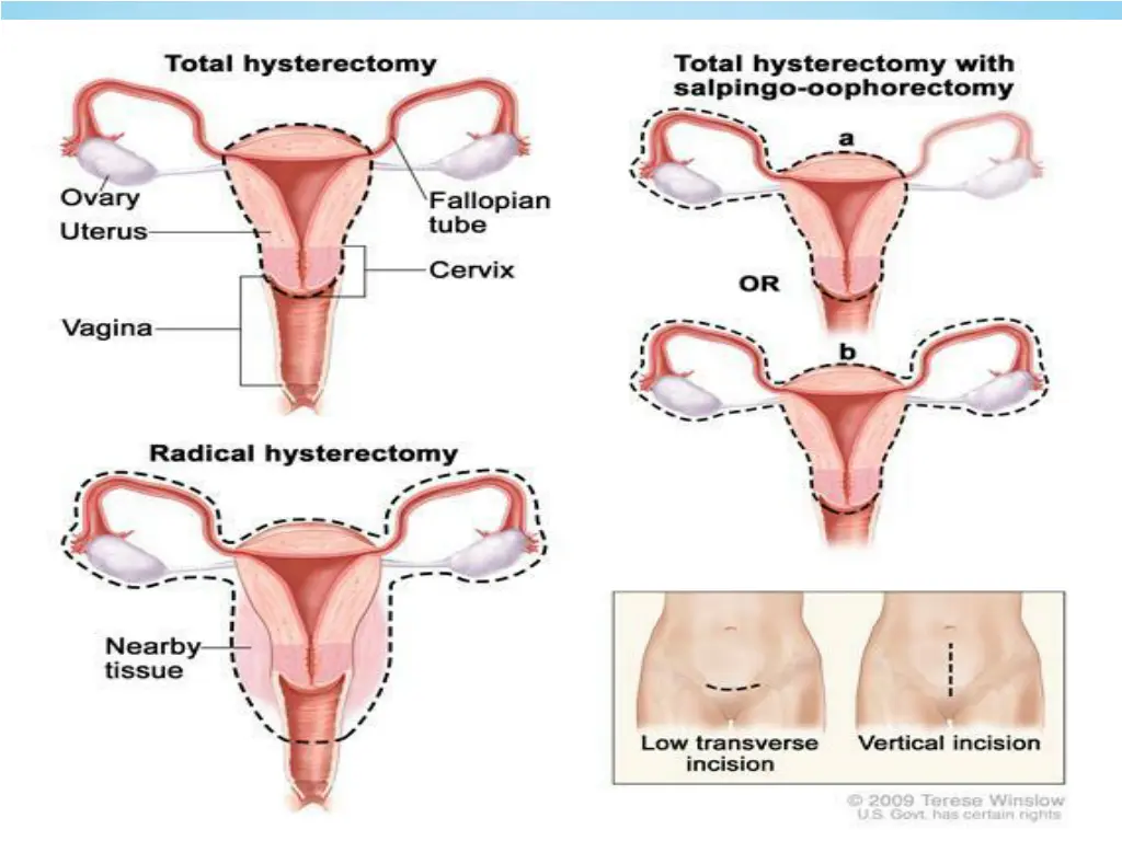 hysterectomy drawing shows the female