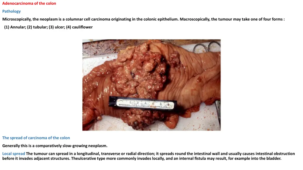 adenocarcinoma of the colon