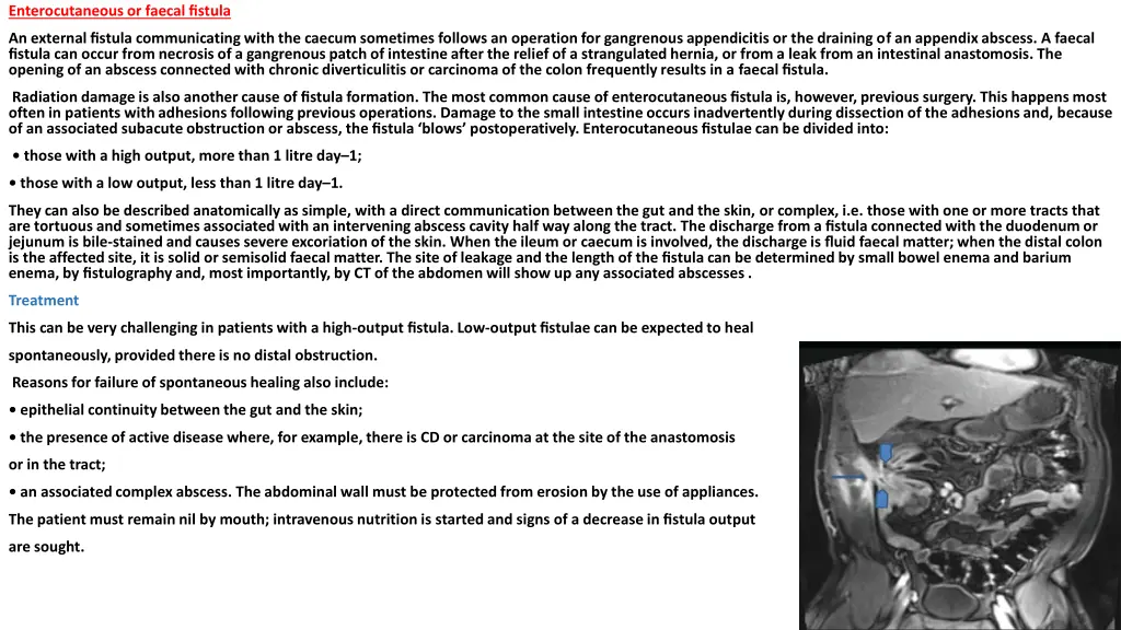 enterocutaneous or faecal fistula