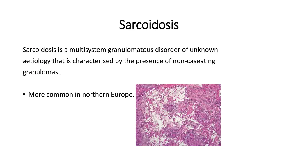 sarcoidosis sarcoidosis