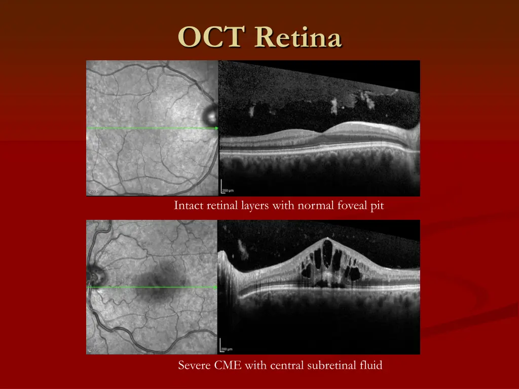 oct retina