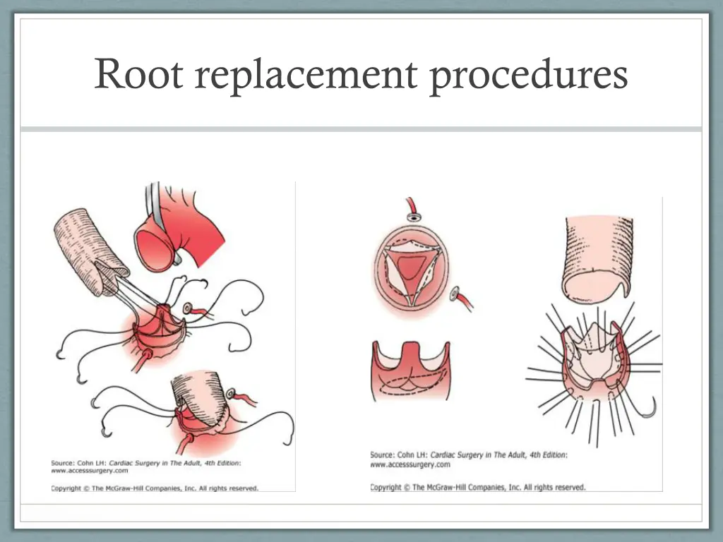 root replacement procedures 2