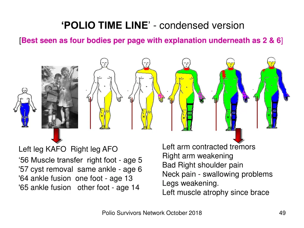 polio time line condensed version best seen
