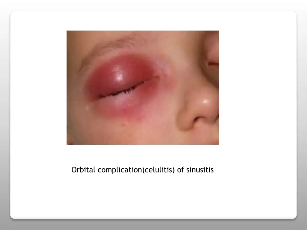 orbital complication celulitis of sinusitis