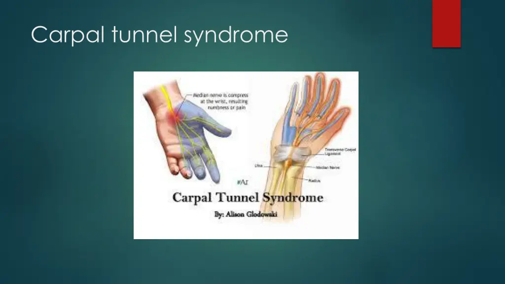 carpal tunnel syndrome 2