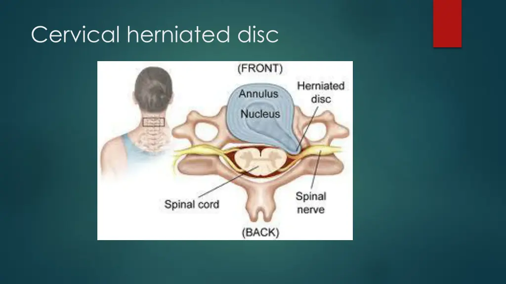 cervical herniated disc