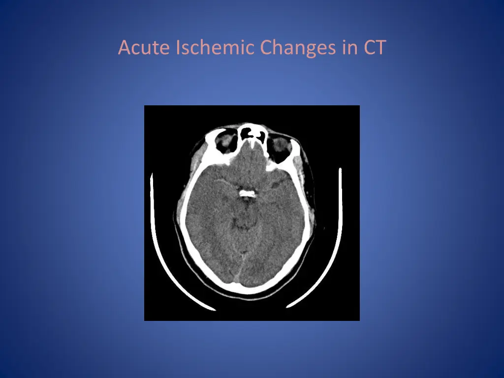 acute ischemic changes in ct 2