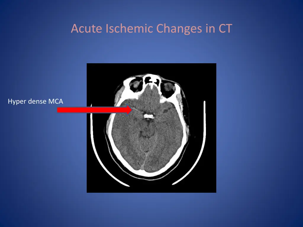 acute ischemic changes in ct 3