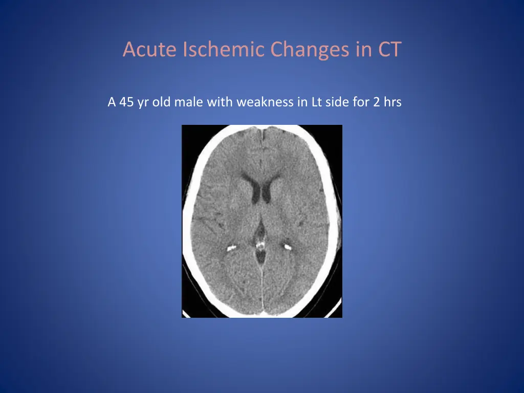 acute ischemic changes in ct 4