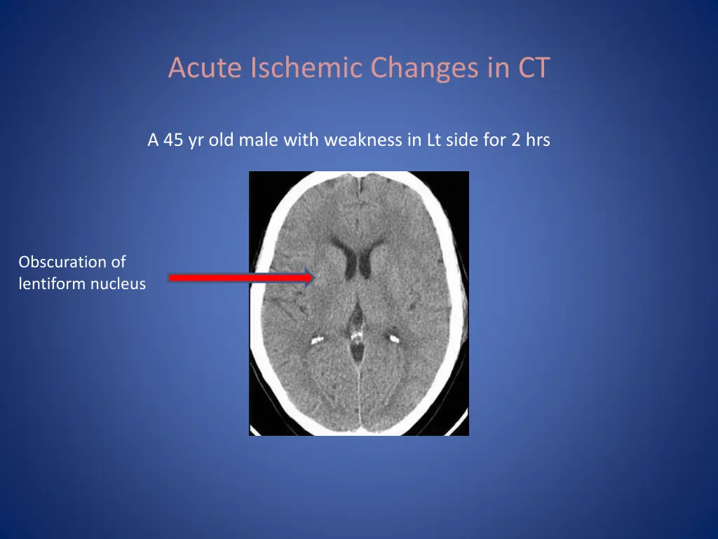 acute ischemic changes in ct 5