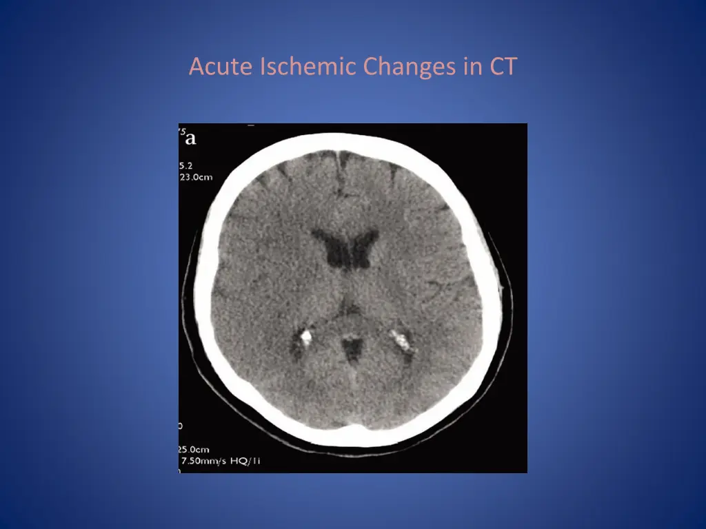 acute ischemic changes in ct
