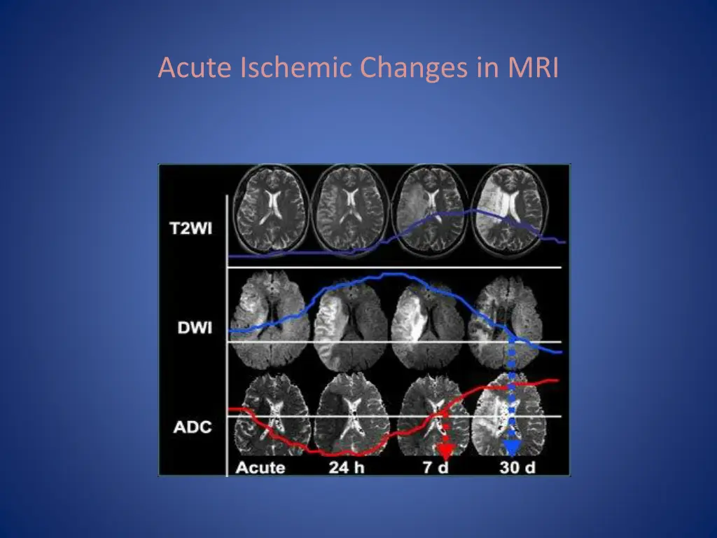 acute ischemic changes in mri