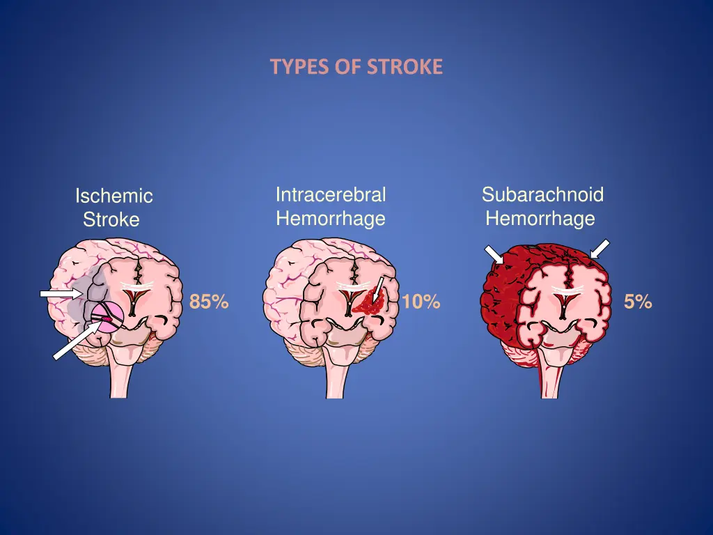 types of stroke