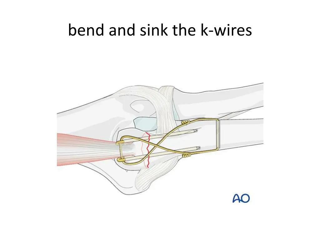 bend and sink the k wires