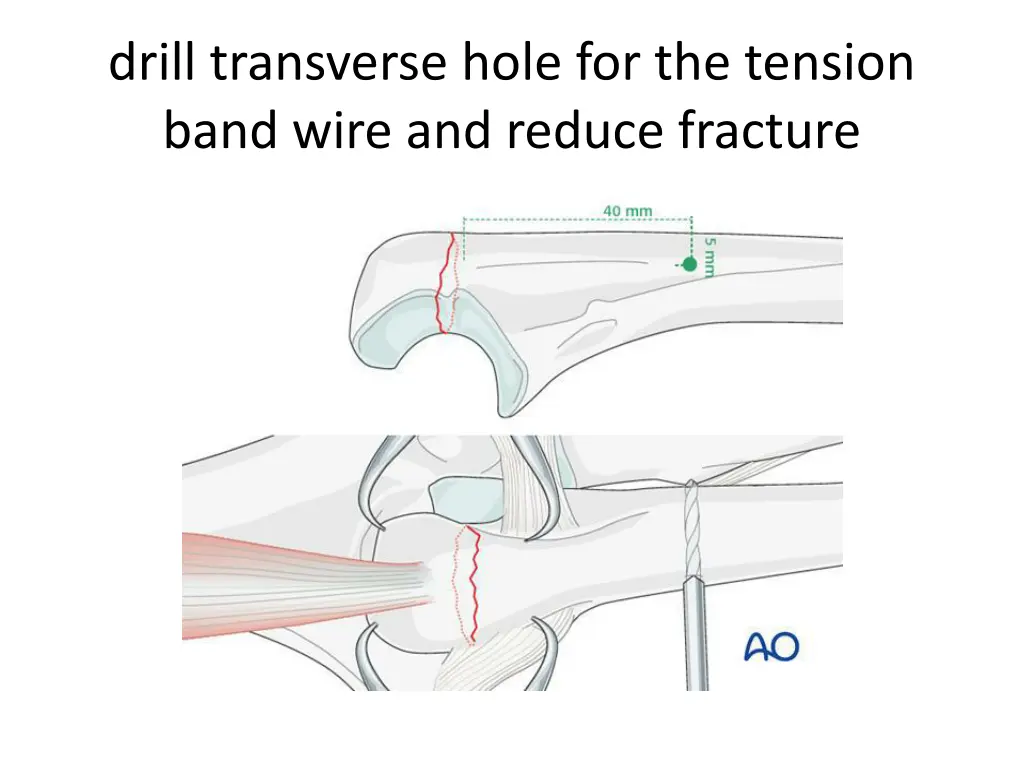 drill transverse hole for the tension band wire