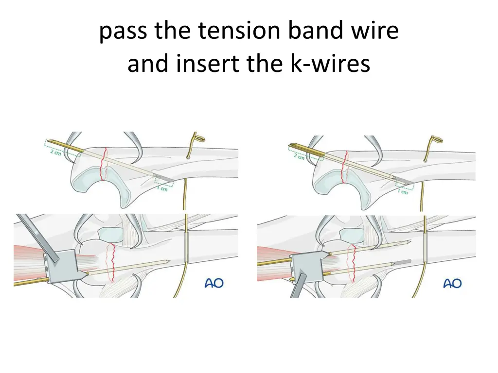pass the tension band wire and insert the k wires