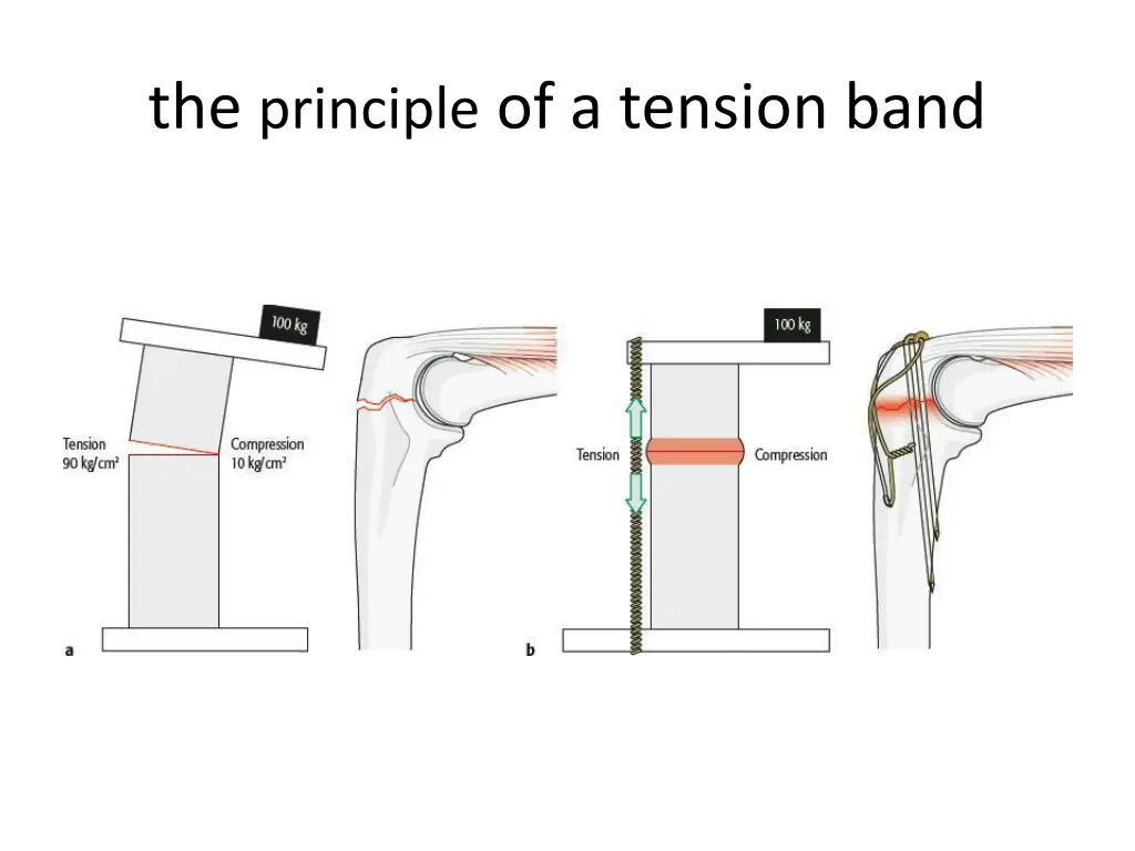 the principle of a tension band
