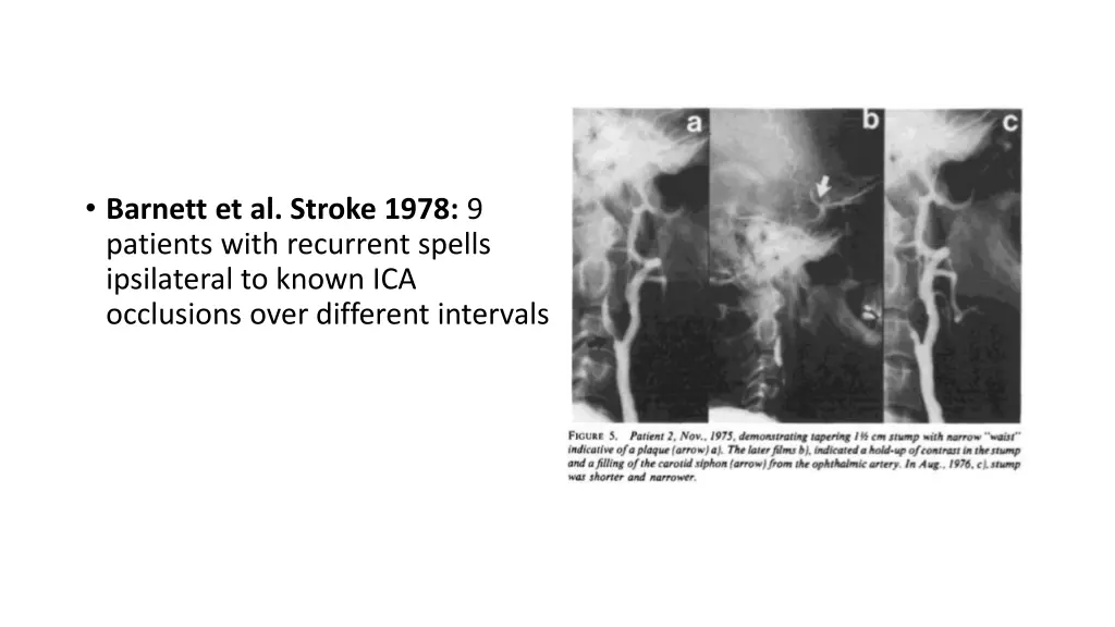 barnett et al stroke 1978 9 patients with
