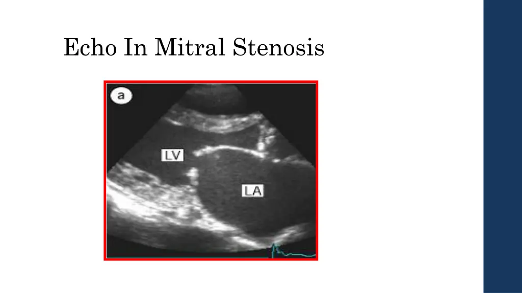 echo in mitral stenosis