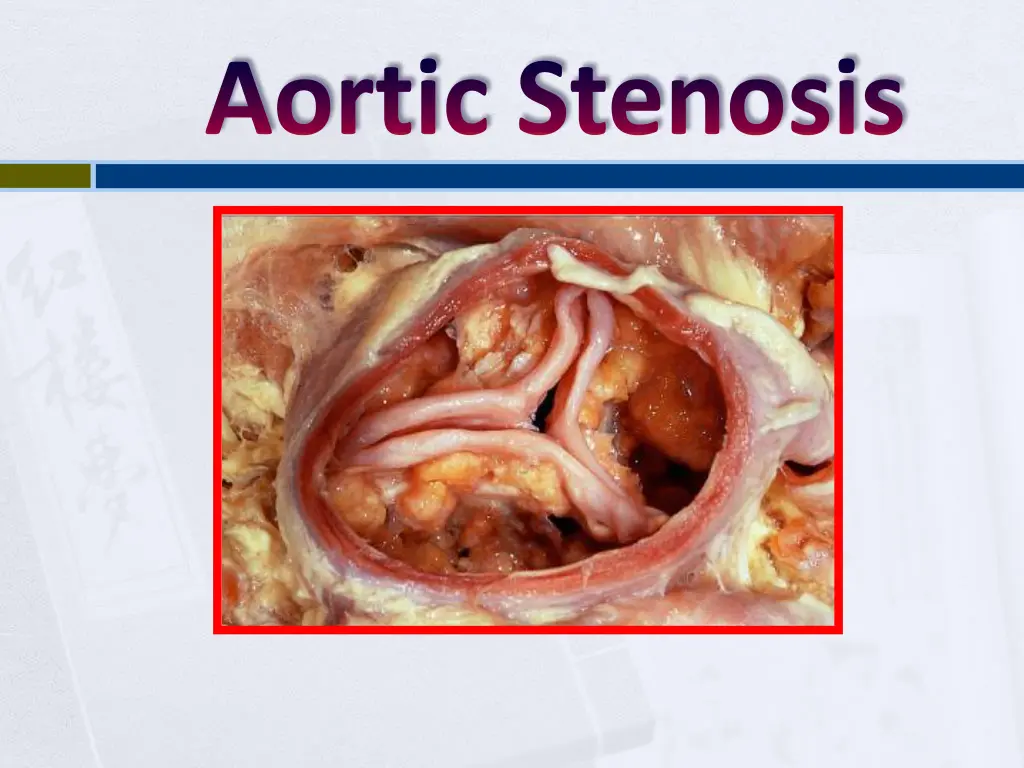 aortic stenosis