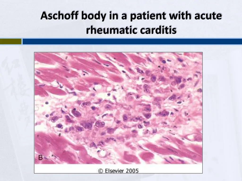 aschoff body in a patient with acute rheumatic
