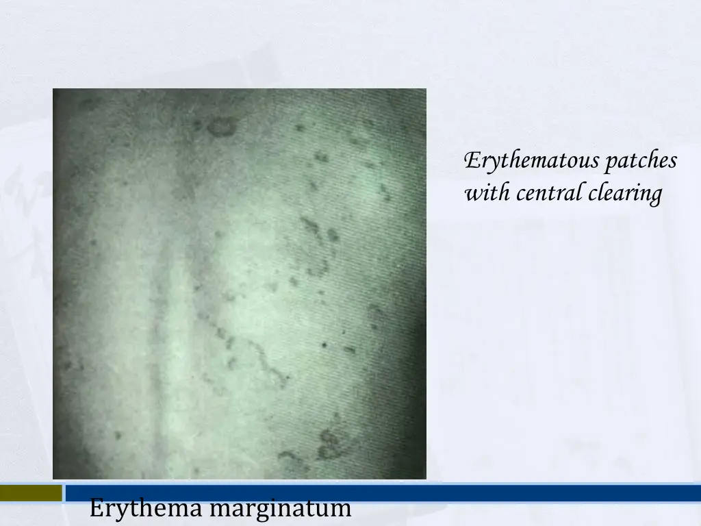 erythematous patches with central clearing