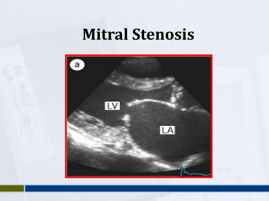 mitral stenosis 2