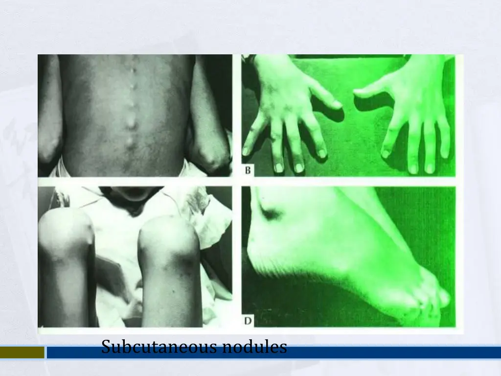 subcutaneous nodules 1