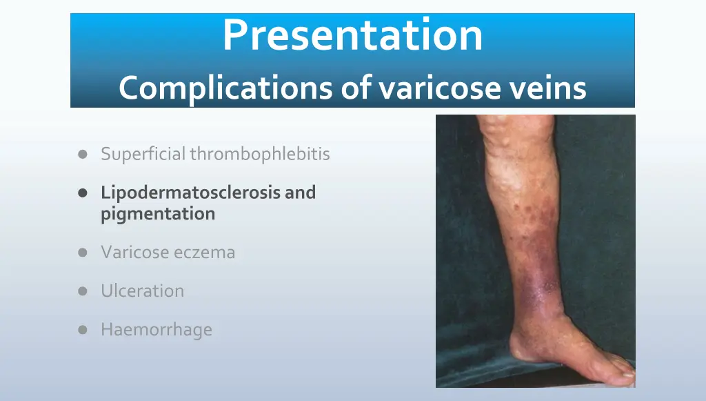 presentation complications of varicose veins 1