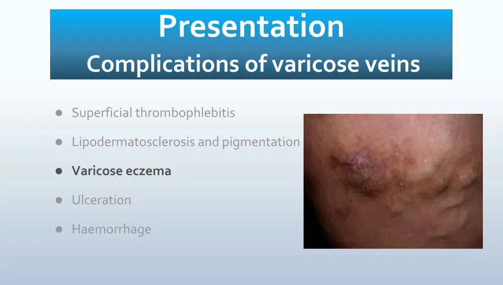 presentation complications of varicose veins 2