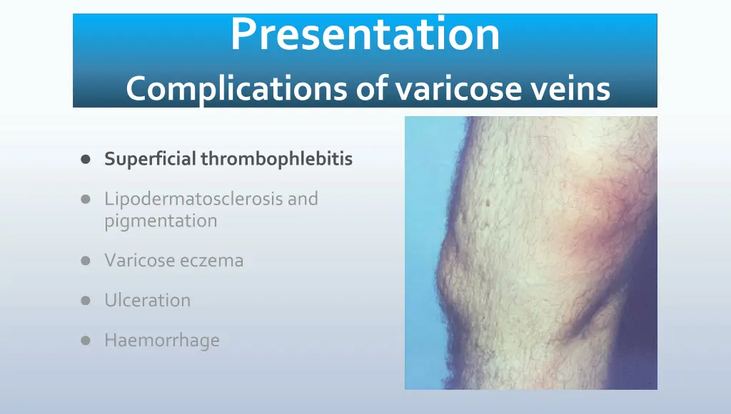 presentation complications of varicose veins