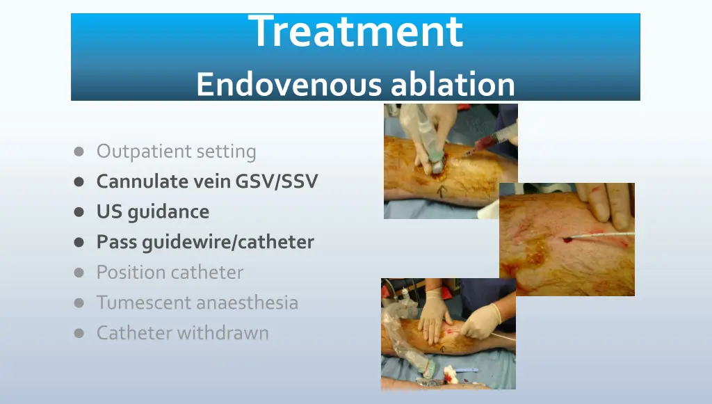 treatment endovenous ablation 1