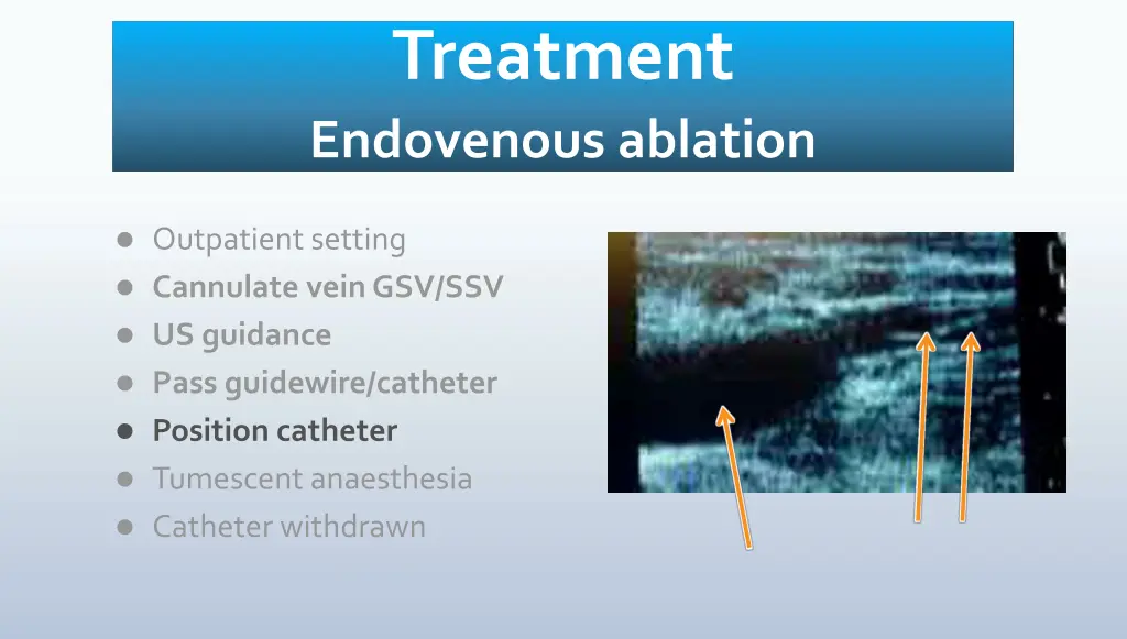 treatment endovenous ablation 2
