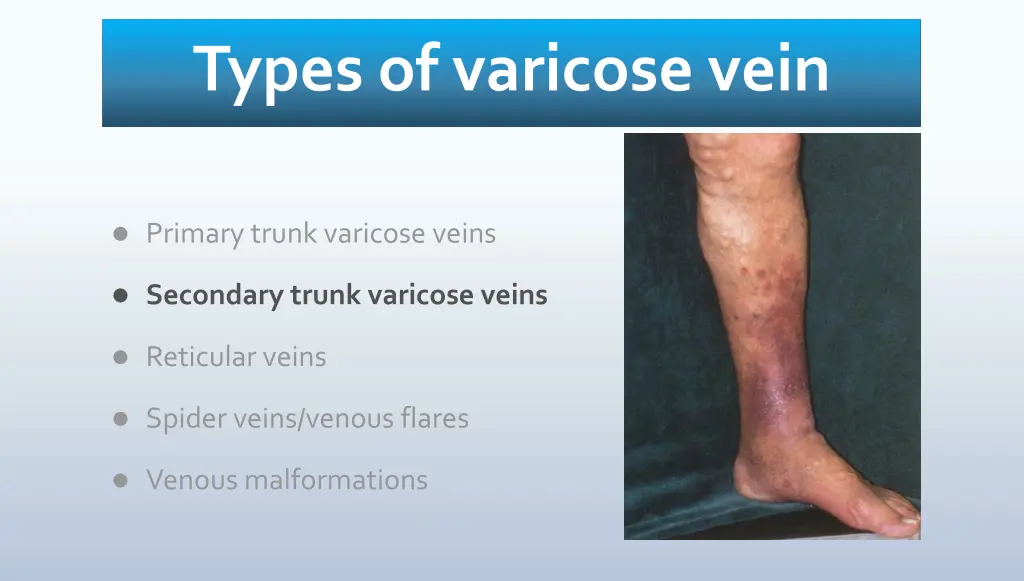 types of varicose vein 1