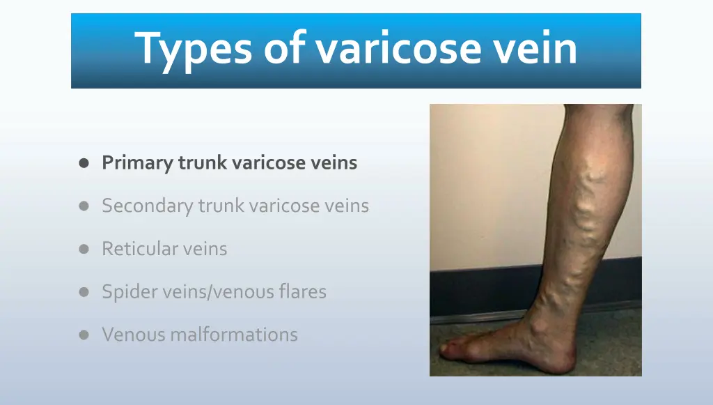 types of varicose vein