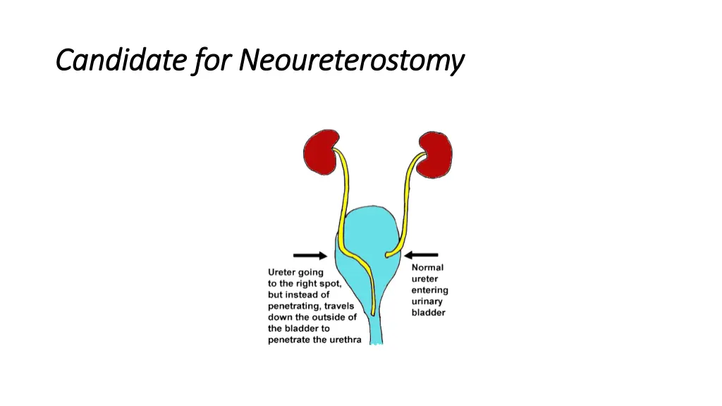 candidate for candidate for neoureterostomy