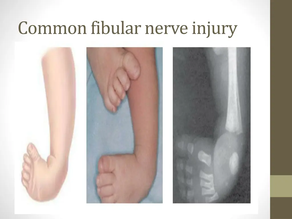 common fibular nerve injury