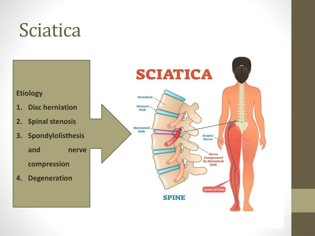 sciatica