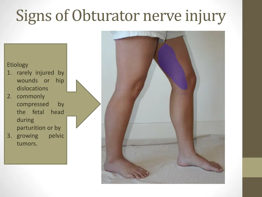 signs of obturator nerve injury