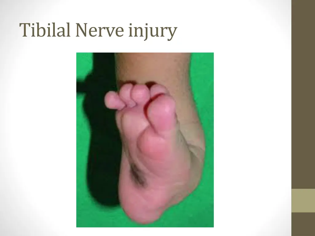 tibilal nerve injury