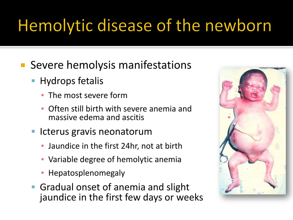 severe hemolysis manifestations hydrops fetalis