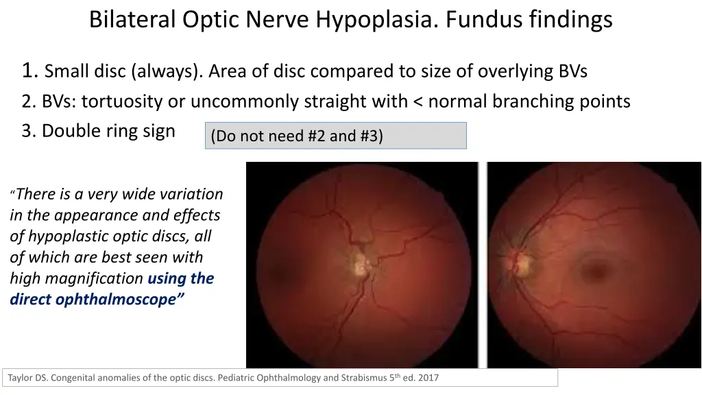 bilateral optic nerve hypoplasia fundus findings